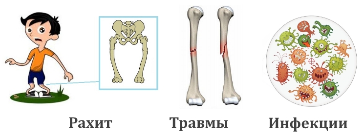 Причины энхондромы Причины энхондромы