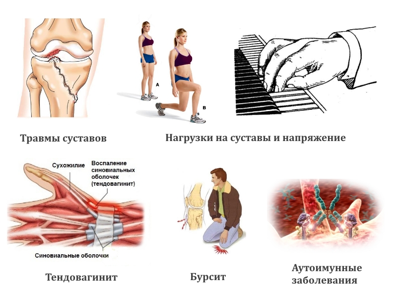 Причины ганглия Причины ганглия