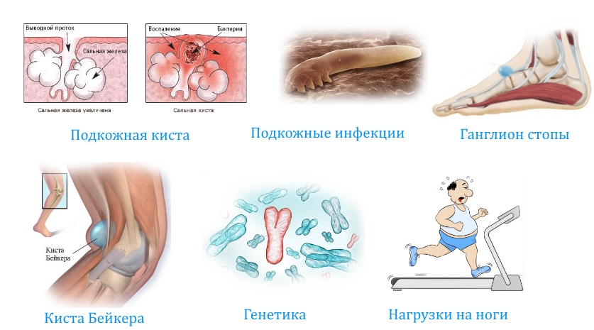 Частые причины кисты на ноге Частые причины кисты на ноге