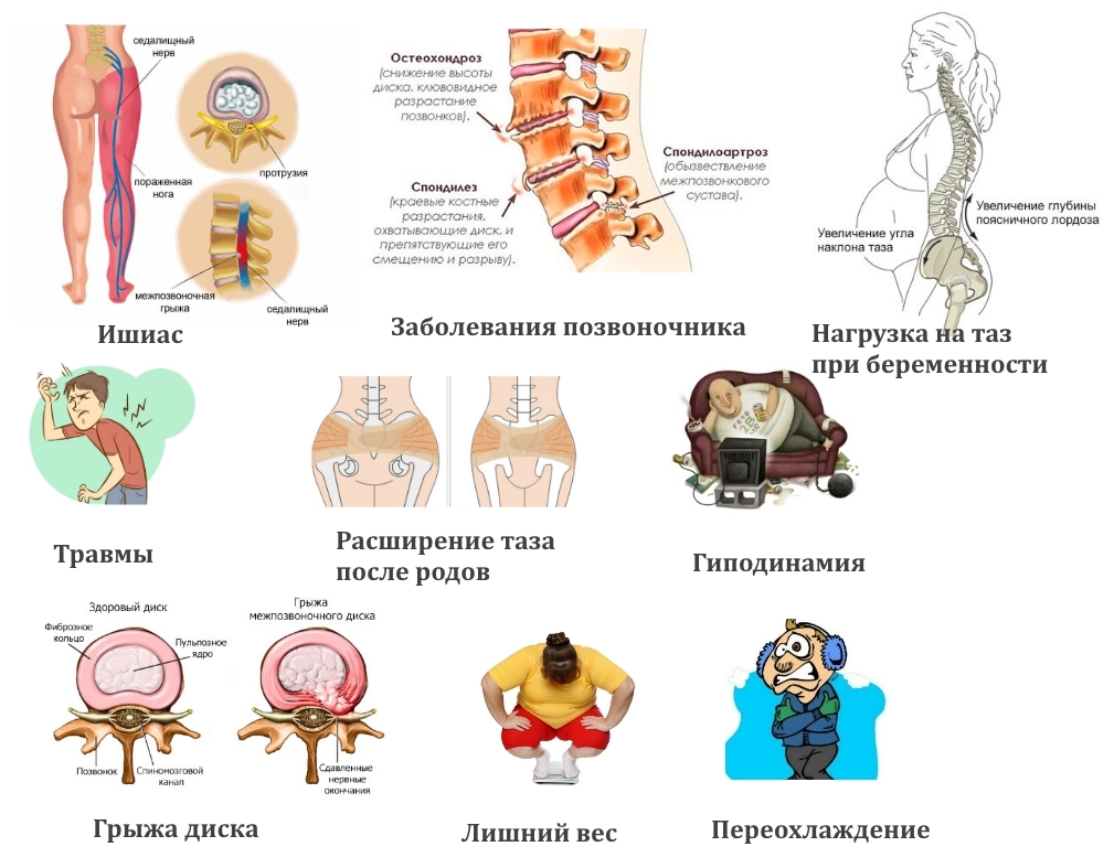 Причины невралгии в области таза Причины невралгии в области таза