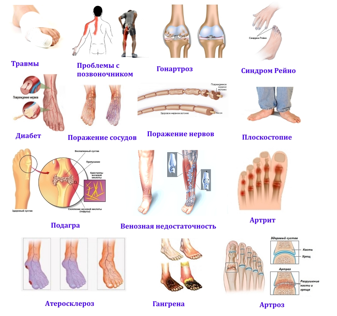 Причины онемения большого пальца стопы Причины онемения большого пальца стопы