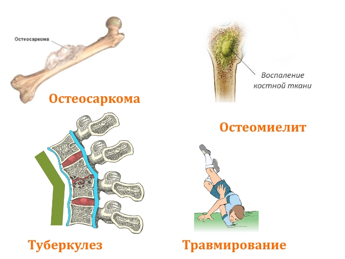 Причины перелома ключицы Причины перелома ключицы