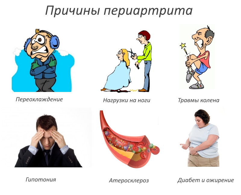 Причины периартрита Причины периартрита