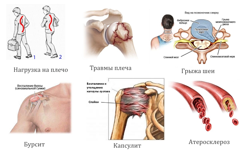Причины периартроза плеча Причины периартроза плеча