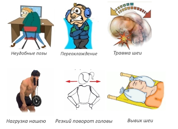 Причины растяжения шеи Причины растяжения шеи