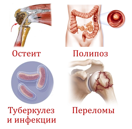 Причины появления саркомы Причины появления саркомы