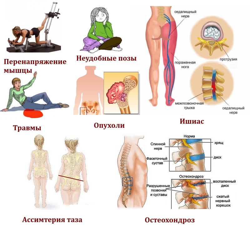Причины развития синдрома грушевидной мышцы Причины развития синдрома грушевидной мышцы