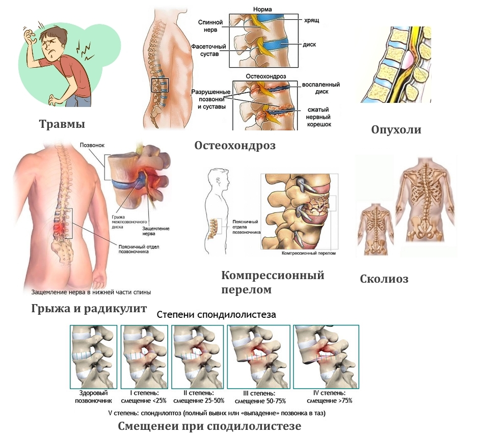 Причины смещения позвонков Причины смещения позвонков