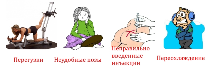 Причины спазма грушевидной мышцы Причины спазма грушевидной мышцы