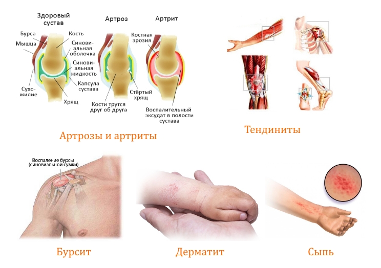 Применение Дипроспана Применение Дипроспана