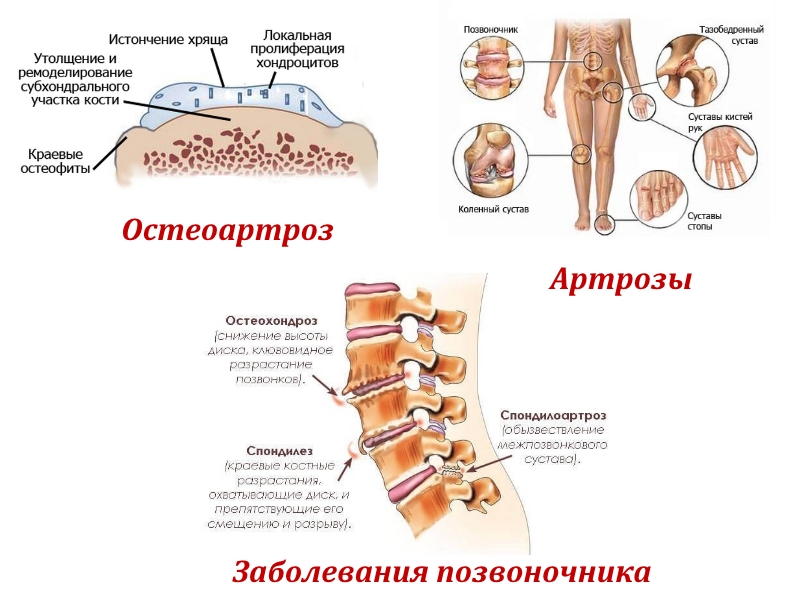Применение Стопартроза Применение Стопартроза