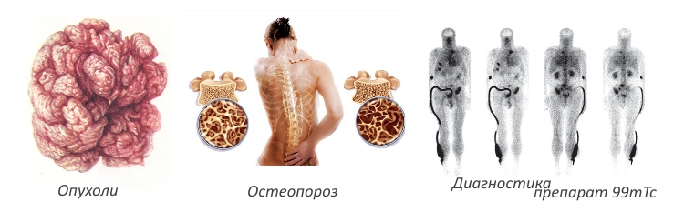 Применение Золедроновой кислоты Применение Золедроновой кислоты