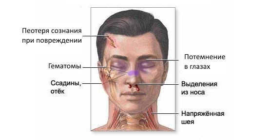 Признаки сильного ушиба носа Признаки сильного ушиба носа