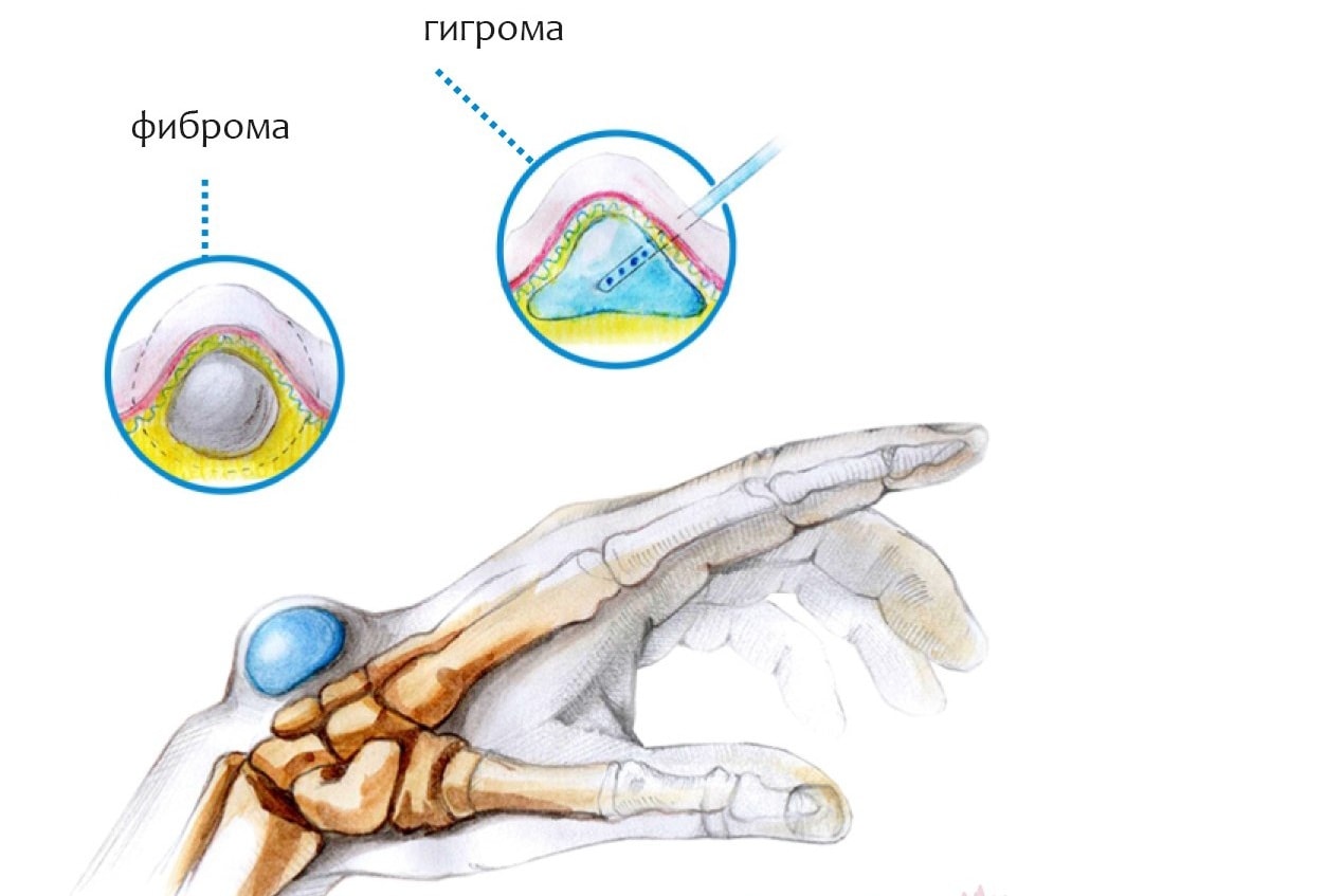 Прокалывание капсулы шишки Прокалывание капсулы шишки