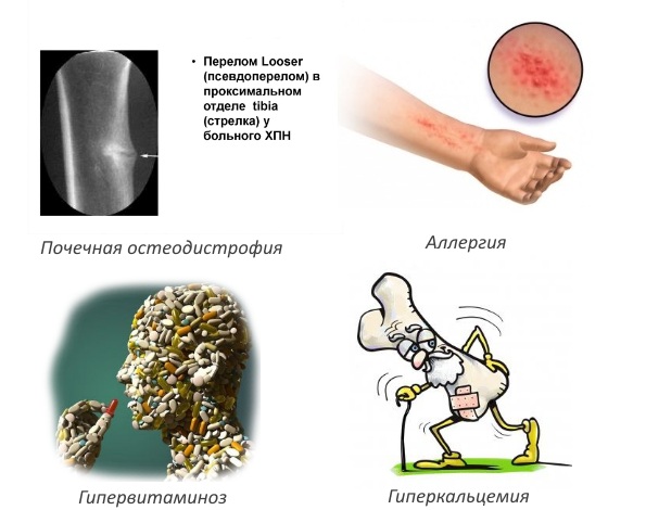 Противопоказания для Альфакальцидола Противопоказания для Альфакальцидола