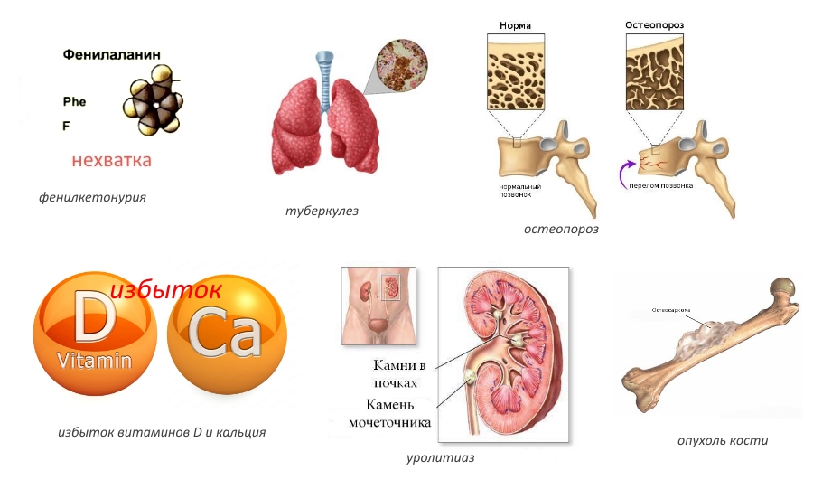 Противопоказания Натекаля Д3 Противопоказания Натекаля Д3