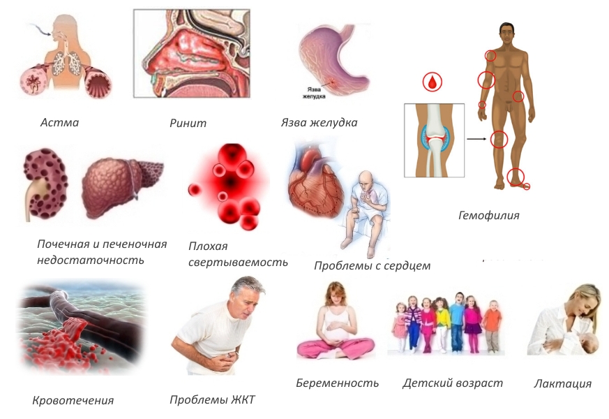 Противопоказания для Кетонала Противопоказания для Кетонала