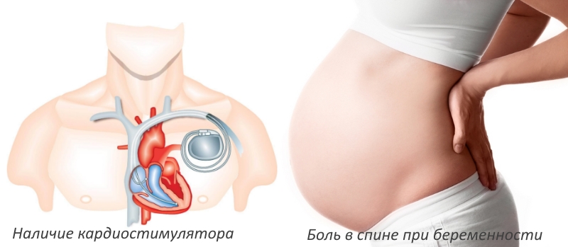 Противопоказания к магнитотерапии Противопоказания к магнитотерапии