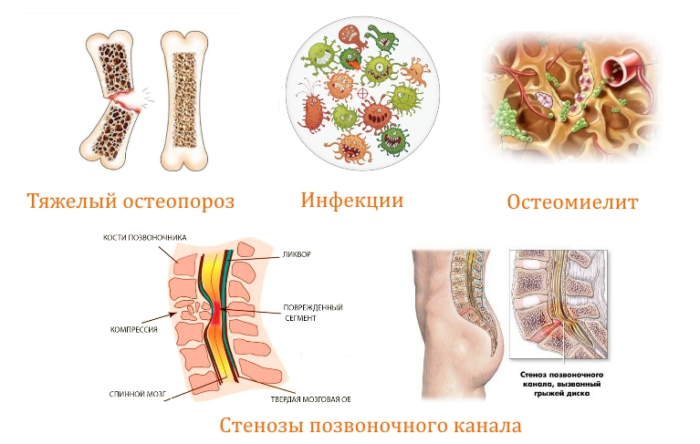 Противопоказания к вертебропластике Противопоказания к вертебропластике