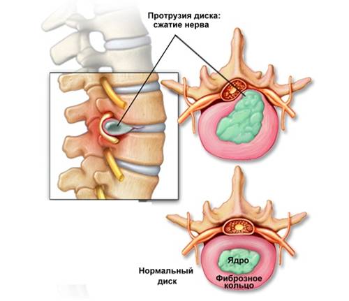 Протрузия позвоночника Протрузия позвоночника