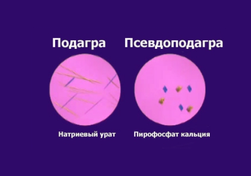 Отличие подагры и псевдоподагры Отличие подагры и псевдоподагры