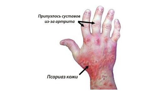 Изменение при псориатическом артрите Изменение при псориатическом артрите
