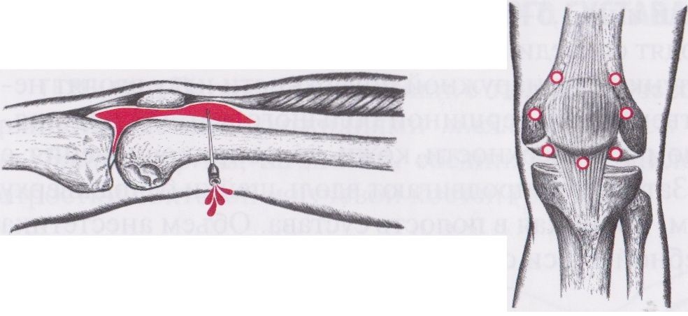 Пункция коленного сустава перед инъекцией Пункция коленного сустава перед инъекцией