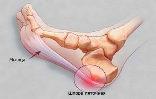 Пяточная шпора Пяточная шпора