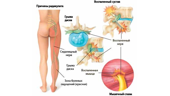 Радикулит позвоночника Радикулит позвоночника