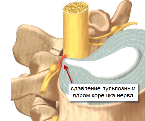Радикулит позвоночника Радикулит позвоночника