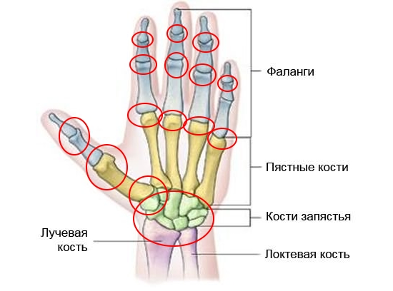 Распространение артроза пальцев рук Распространение артроза пальцев рук