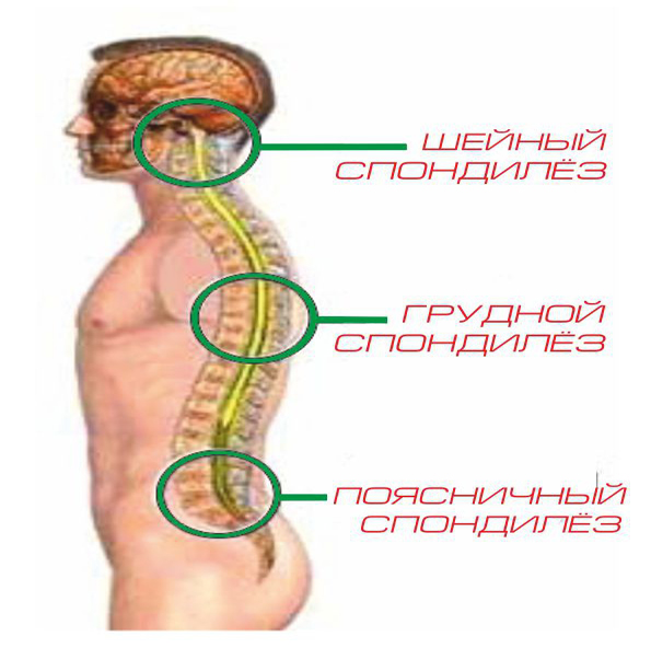 Распространение спондилеза Распространение спондилеза