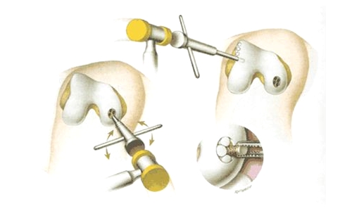 Оперативное лечение рассекающего остеохондрита Оперативное лечение рассекающего остеохондрита