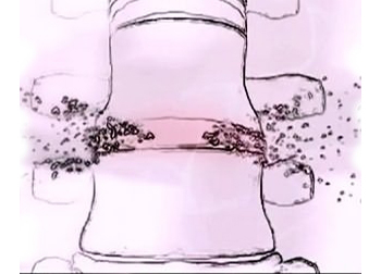 Размягчение хрящевой ткани грыжи Карипазимом Размягчение хрящевой ткани грыжи Карипазимом