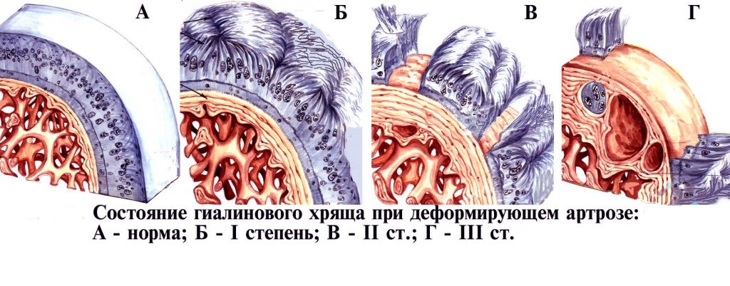 Разрушение хряща при артрозе Разрушение хряща при артрозе