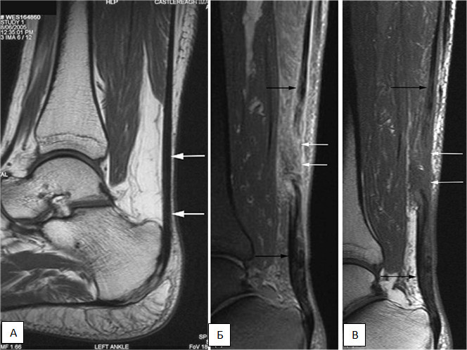 МРТ диагностика разрыва МРТ диагностика разрыва