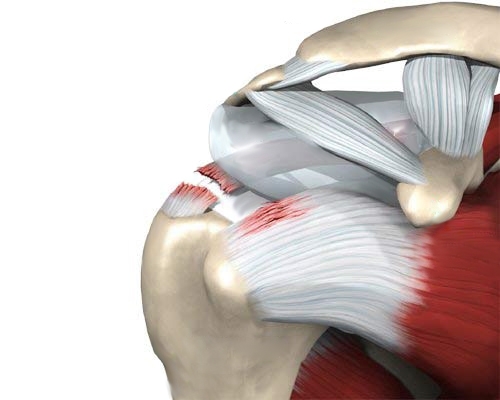 Разрыв сухожилия надостной мышцы Разрыв сухожилия надостной мышцы