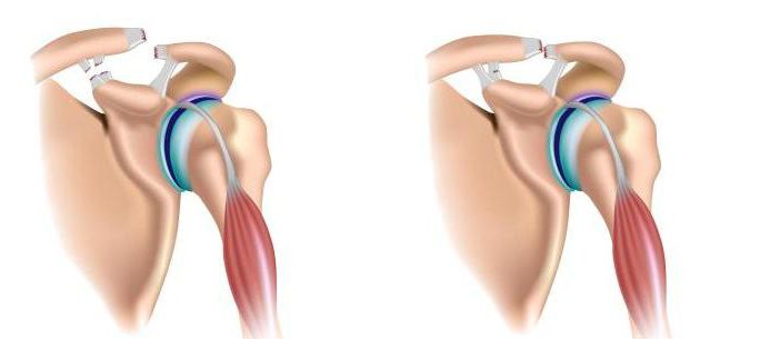 Образование разрыва связок плечевого сустава Образование разрыва связок плечевого сустава