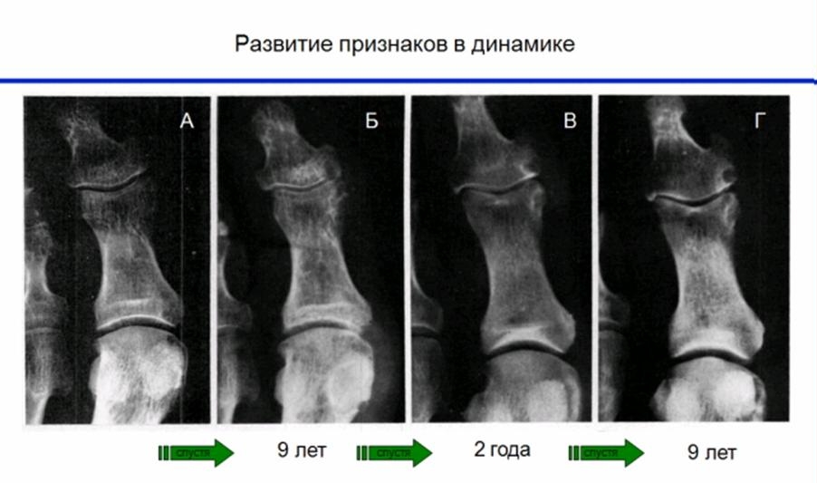 Диагностика подагры рентгеном Диагностика подагры рентгеном