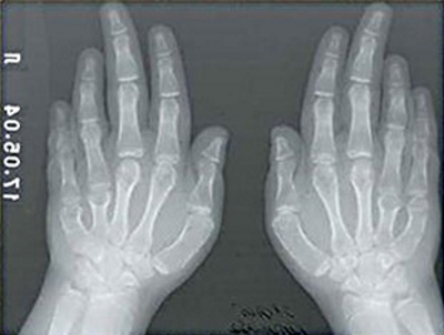 Рентгеновский снимок рук Рентгеновский снимок рук