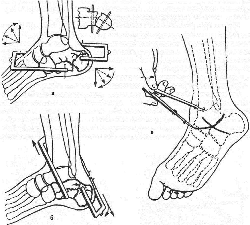 Репозиция отломков пяточной кости Репозиция отломков пяточной кости
