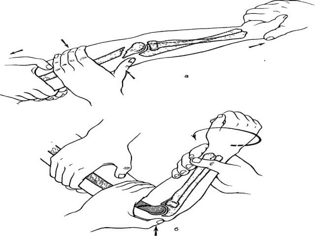 Перелом лучевой кости руки Перелом лучевой кости руки
