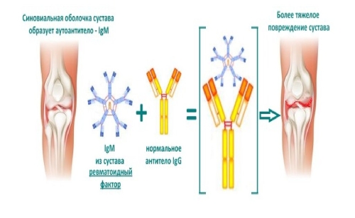 Ревматоидный фактор в крови Ревматоидный фактор в крови