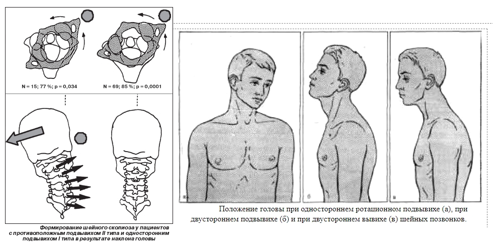 Ротационный подвывих шейного позвонка Ротационный подвывих шейного позвонка