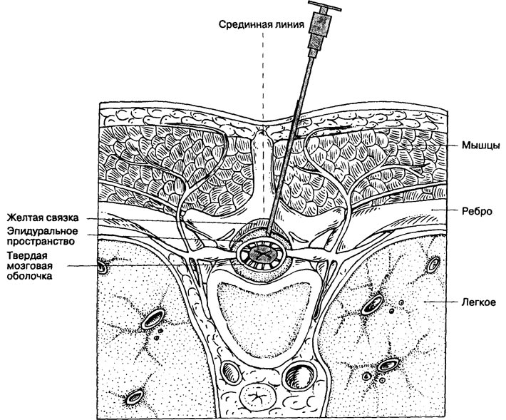 Схема эпидуральной блокады позвоночника Схема эпидуральной блокады позвоночника