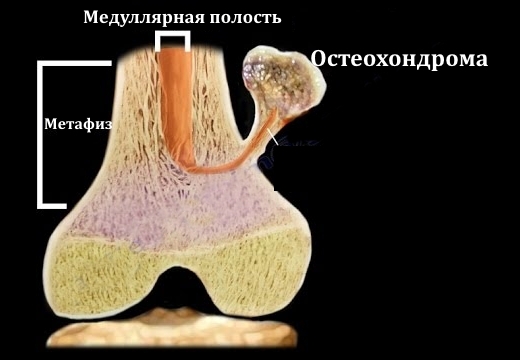 Схема остеохондромы Схема остеохондромы