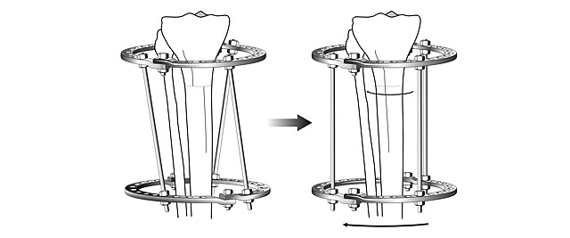 Схема ротационной коррекции в аппарате Илизарова Схема ротационной коррекции в аппарате Илизарова