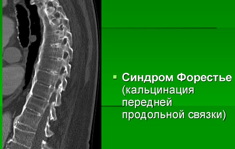 Синдром Форестье Синдром Форестье