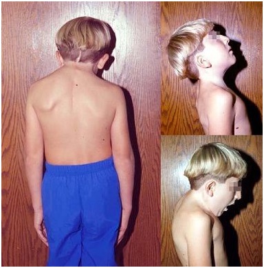 Фото синдром Клиппеля–Фейля Фото синдром Клиппеля–Фейля