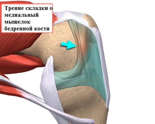 Суть синдрома медиопателлярной складки коленного сустава Суть синдрома медиопателлярной складки коленного сустава